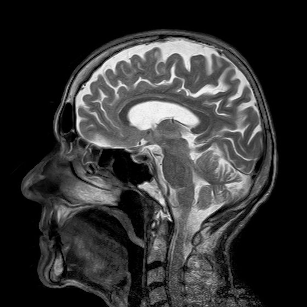 Sagittal Head MRI Scan